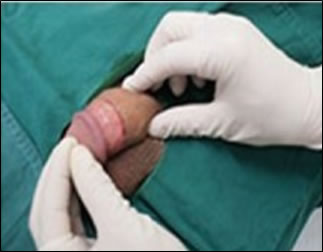 Staple Procedure 4